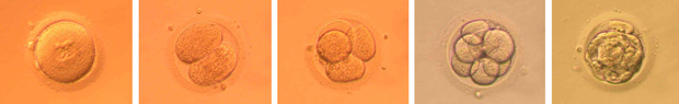 IVF (in vitro fertilization)